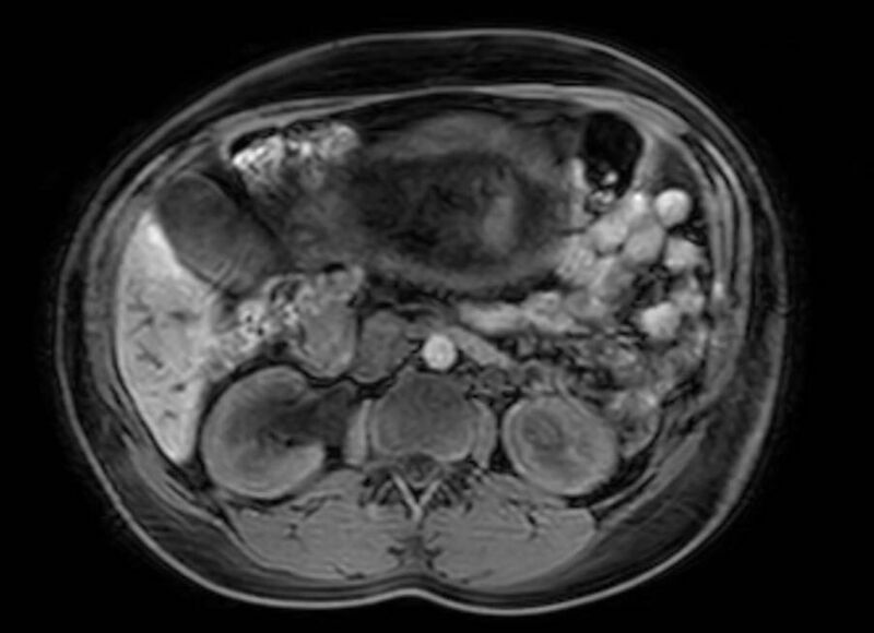 File:Appendicitis in gravida (MRI) (Radiopaedia 89433-106395 Axial DIXON 54).jpg