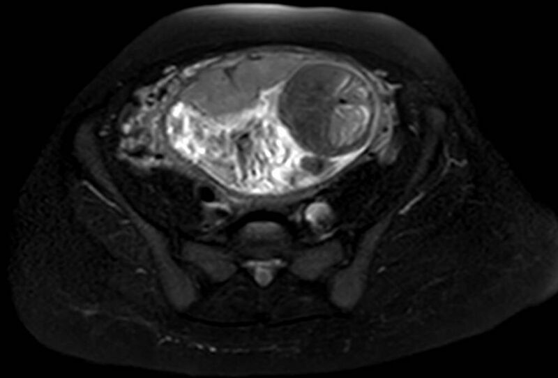 File:Appendicitis in gravida (MRI) (Radiopaedia 89433-106395 Axial T2 SPAIR 55).jpg