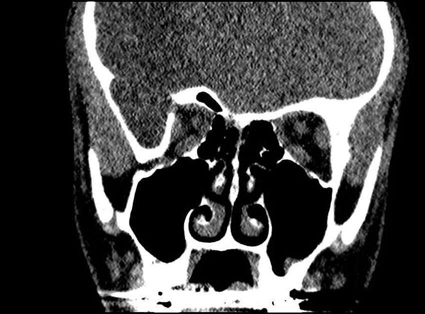 Arachnoid cyst- extremely large (Radiopaedia 68741-78450 Coronal bone window 43).jpg