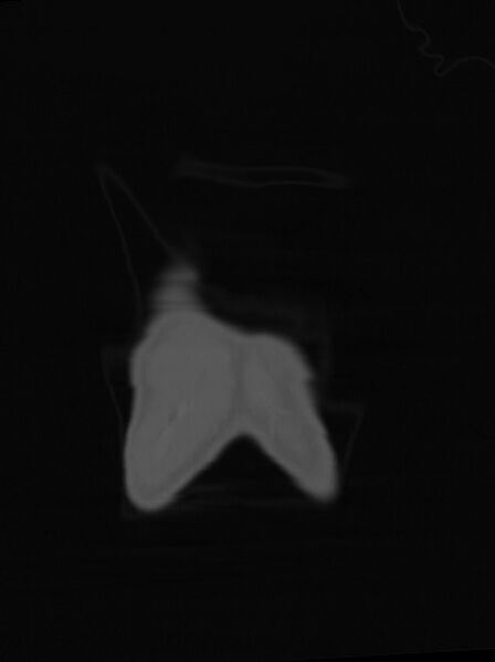 File:Arrow injury to the neck (Radiopaedia 75225-86323 Coronal bone window 6).jpg