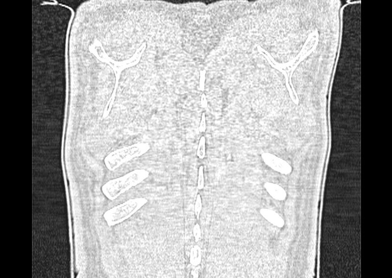 File:Asbestos pleural placques (Radiopaedia 57905-64872 Coronal lung window 287).jpg
