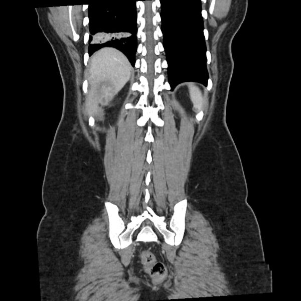 File:Ascending retrocecal appendicitis with liver abscesses (Radiopaedia 60066-67615 C 1).jpg