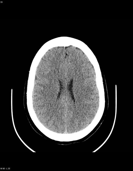 File:Astroblastoma (Radiopaedia 39792-42216 Axial non-contrast 32).jpg
