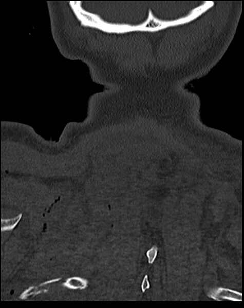 File:Atlanto-occipital dissociation - Traynelis type 1 (Radiopaedia 87570-103948 Coronal bone window 57).jpg