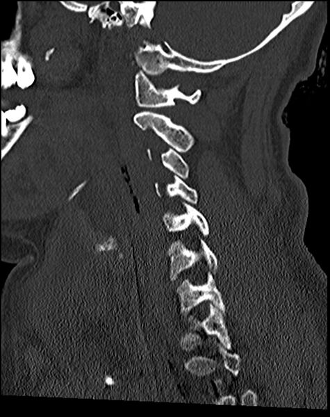 File:Atlanto-occipital dissociation - Traynelis type 1 (Radiopaedia 87570-103948 Sagittal bone window 54).jpg