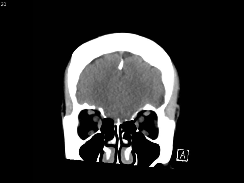 Atypical meningioma - intraosseous (Radiopaedia 64915-73867 B 19).jpg