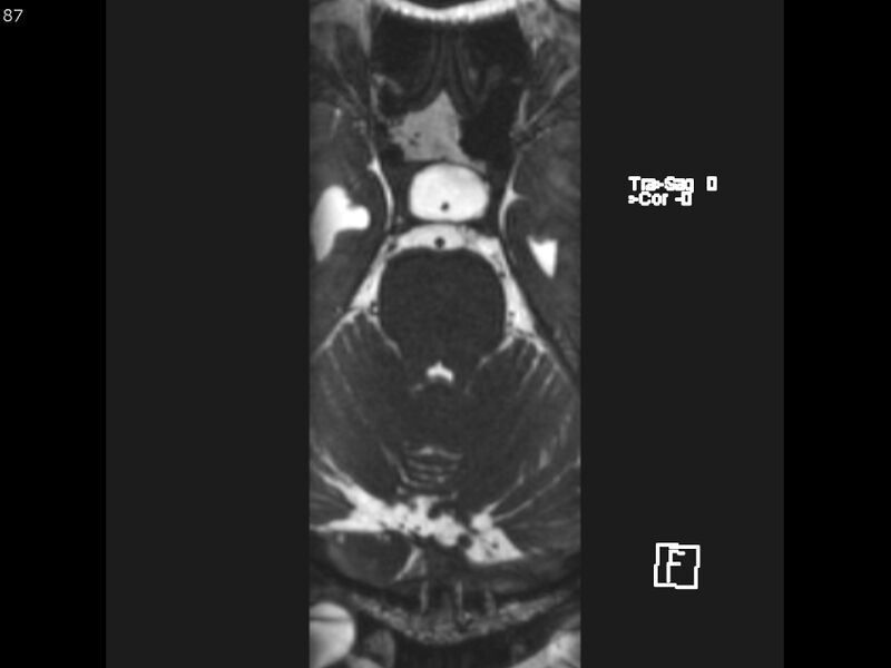 File:Atypical meningioma - intraosseous (Radiopaedia 64915-74572 Axial CISS 87).jpg
