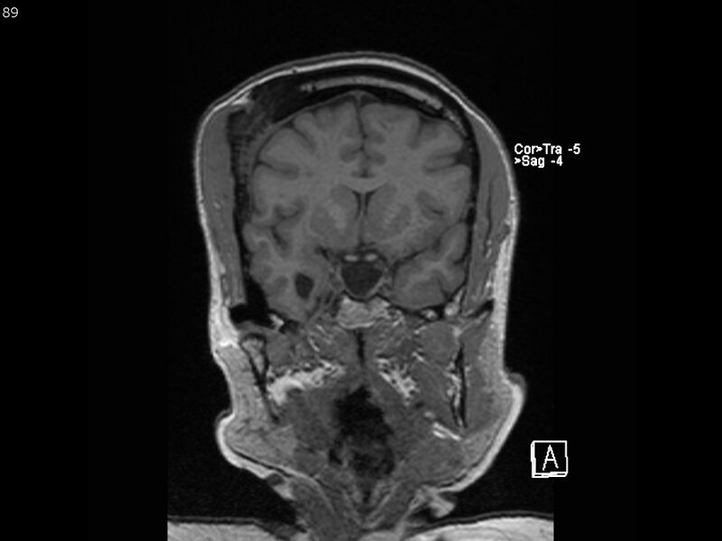 File:Atypical meningioma - intraosseous (Radiopaedia 64915-74572 Coronal T1 89).jpg