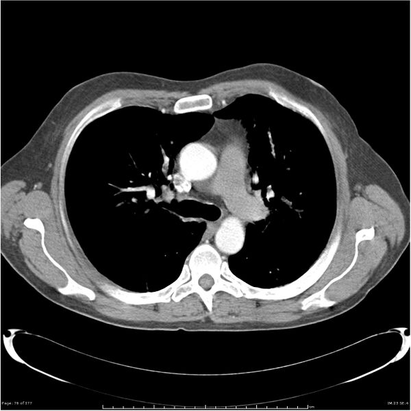 File:Atypical pneumonia - Q fever (Radiopaedia 21993-21989 C+ arterial phase 18).jpg