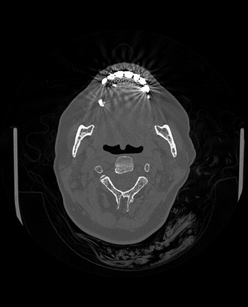File:Automastoidectomy with labyrinthine fistula (Radiopaedia 84143-99411 Axial non-contrast 4).jpg