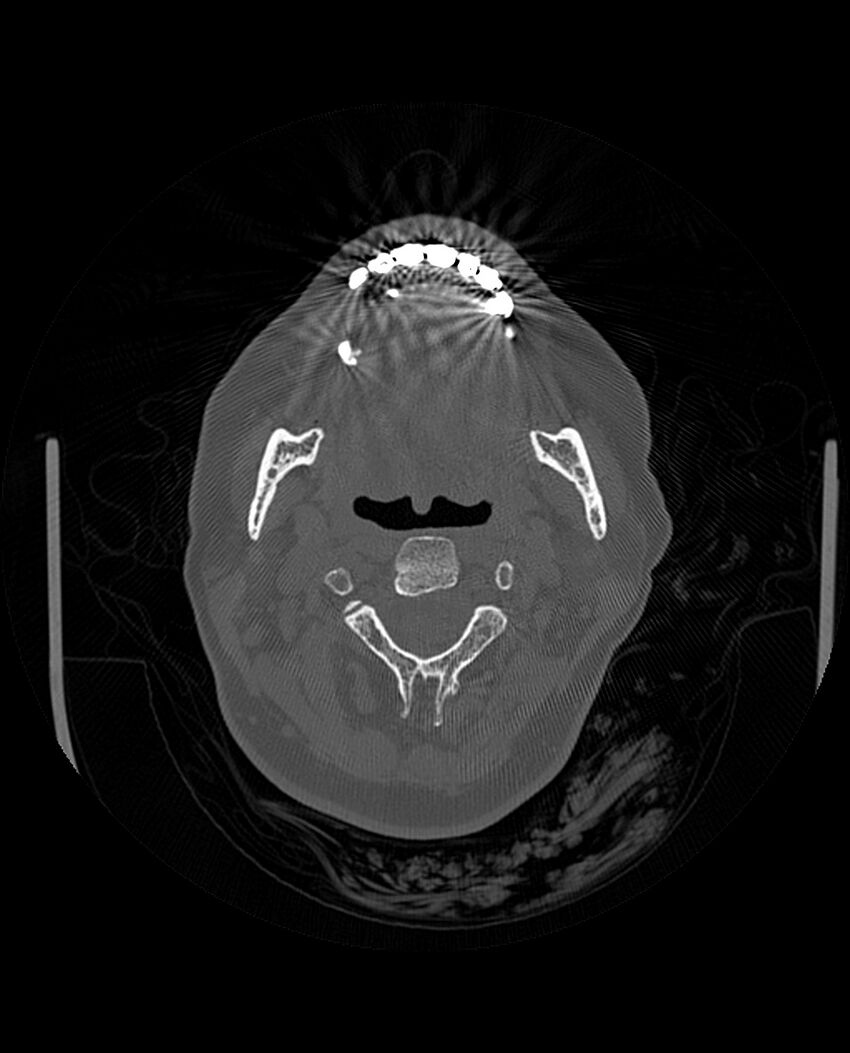 Automastoidectomy with labyrinthine fistula (Radiopaedia 84143-99411 Axial non-contrast 4).jpg