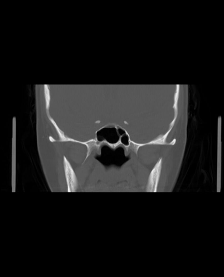 Automastoidectomy with labyrinthine fistula (Radiopaedia 84143-99411 Coronal non-contrast 67).jpg