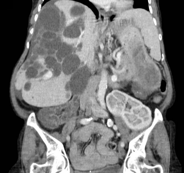 File:Autosomal dominant polycystic kidney disease (Radiopaedia 16777-16490 B 25).jpg