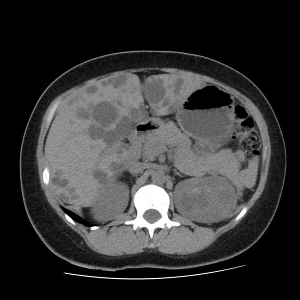File:Autosomal dominant polycystic kidney disease (Radiopaedia 23061-23093 Axial non-contrast 20).jpg