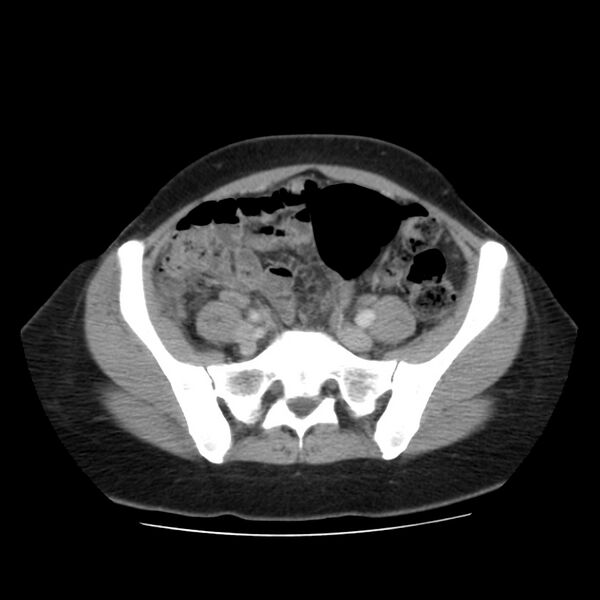 File:Autosomal dominant polycystic kidney disease (Radiopaedia 23061-23093 C 52).jpg