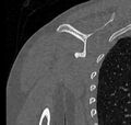Avulsion fracture - greater tuberosity of humerus (Radiopaedia 71216-81514 Coronal bone window 50).jpg