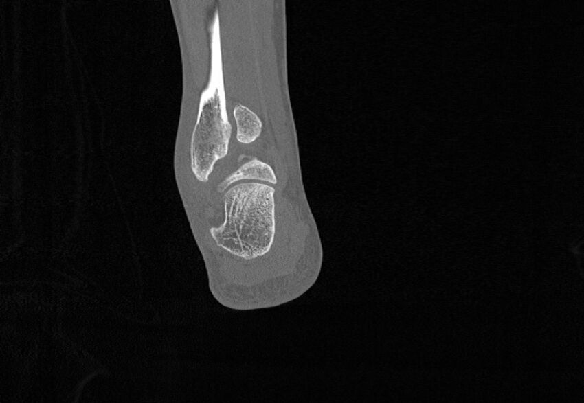 Avulsion fractures of talus and calcaneus (Radiopaedia 48277-53155 Coronal bone window 82).jpg