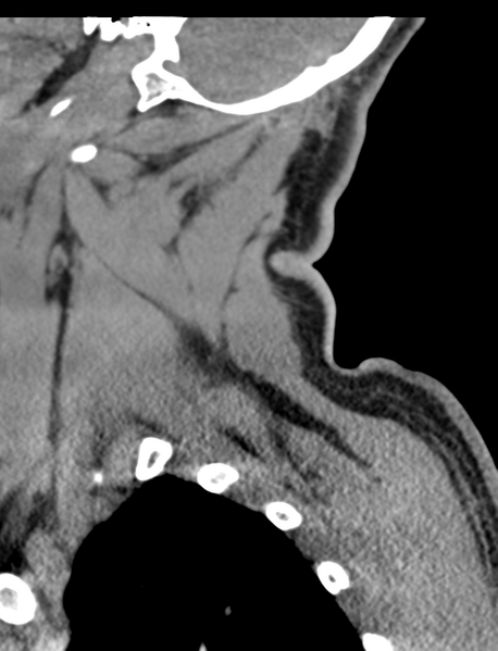 File:Axis peg fracture (type 3) and atlas lateral mass (type 4) fracture (Radiopaedia 37474-39324 D 10).png