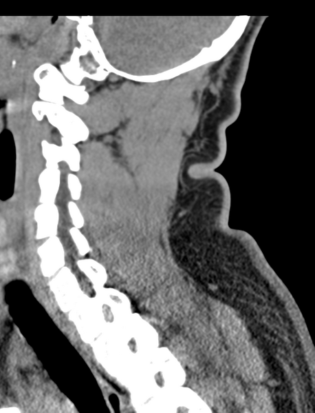 File:Axis peg fracture (type 3) and atlas lateral mass (type 4) fracture (Radiopaedia 37474-39324 D 47).png