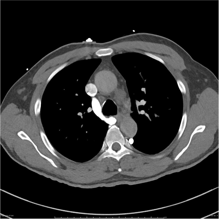 Azygos venous system anatomy (CT pulmonary angiography) (Radiopaedia 25928-26077 Axial C+ CTPA 29).jpg