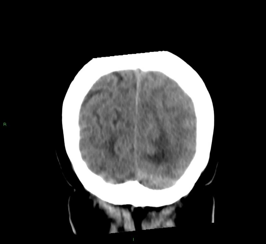 Basal ganglia hemorrhage (Radiopaedia 58759-65981 Coronal non-contrast 17).jpg