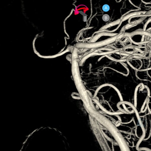 File:Basilar artery perforator aneurysm (Radiopaedia 82455-97734 3D view left VA 25).jpg