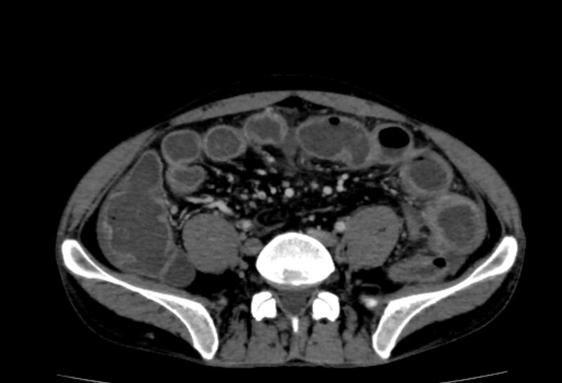File:Behçet's disease. abdominal vasculitis (Radiopaedia 55955-62570 Axial 12).jpg