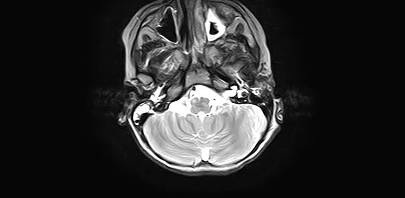 File:Bilateral Sprengel deformity with Klippel-Feil syndrome (Radiopaedia 66395-75650 Axial T2 1).jpg