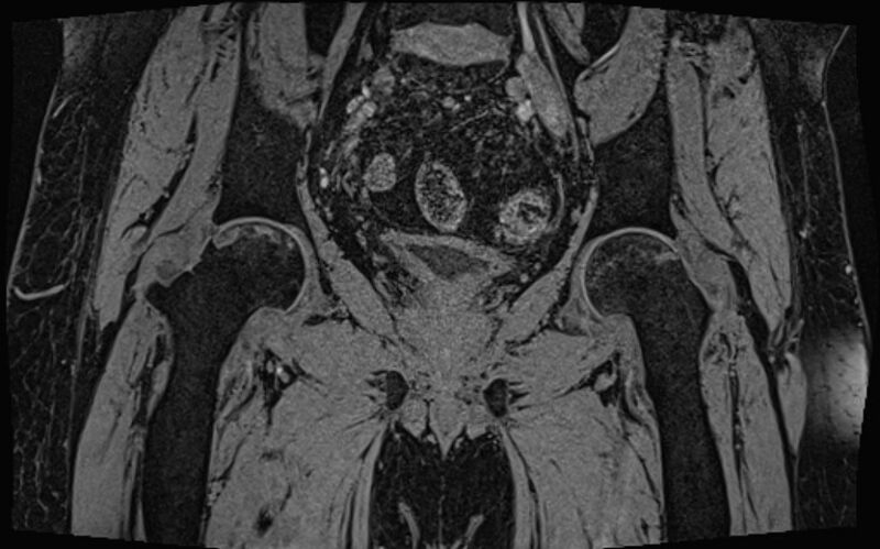 File:Bilateral avascular necrosis of femoral head (Radiopaedia 77116-89078 Coronal T2 we 36).jpg