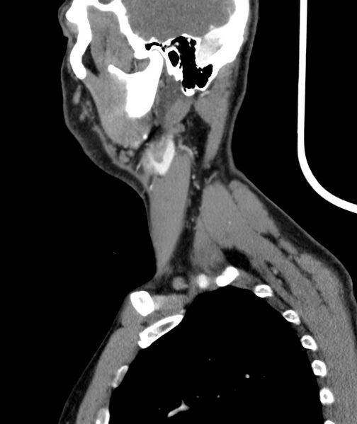 File:Bilateral carotid body tumors (Radiopaedia 52899-58827 C 2).jpg