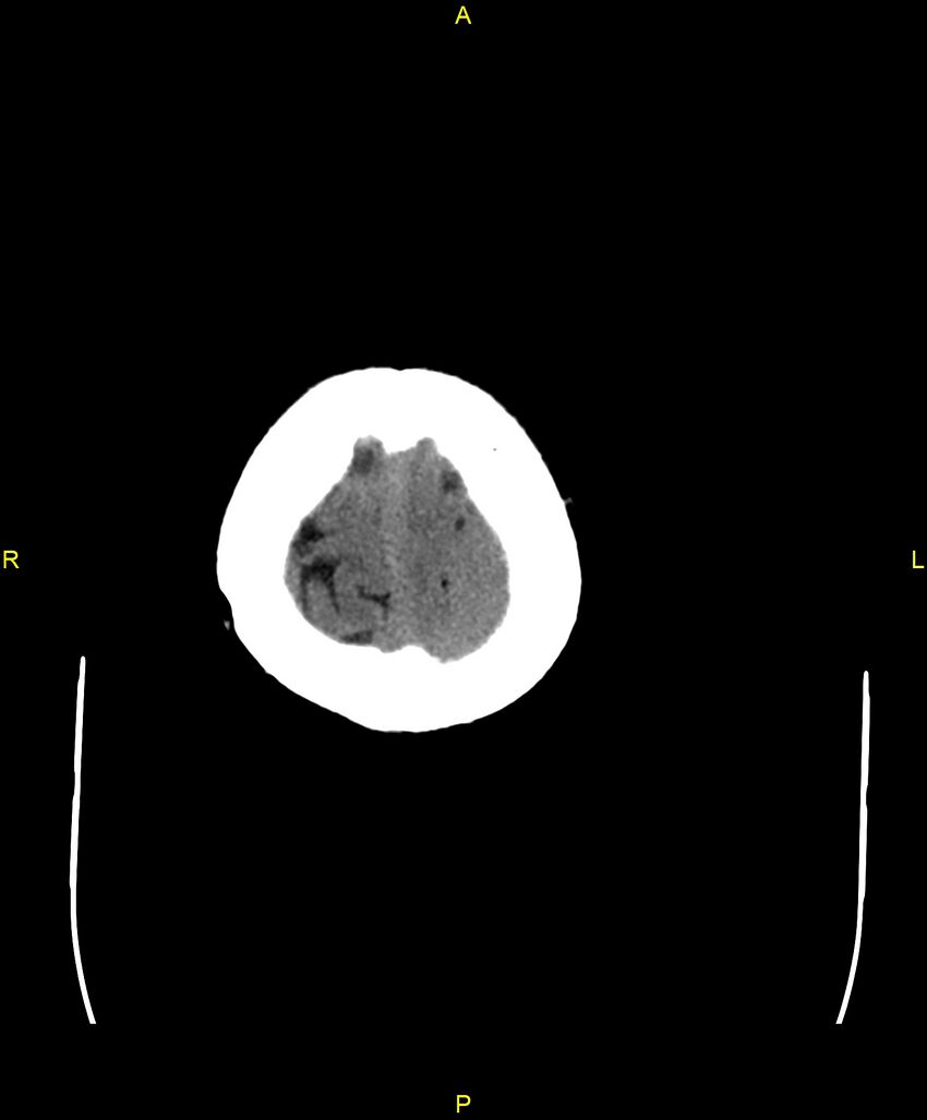 Bilateral isodense subdural hematomas (Radiopaedia 88621-105325 Axial non-contrast 103).jpg