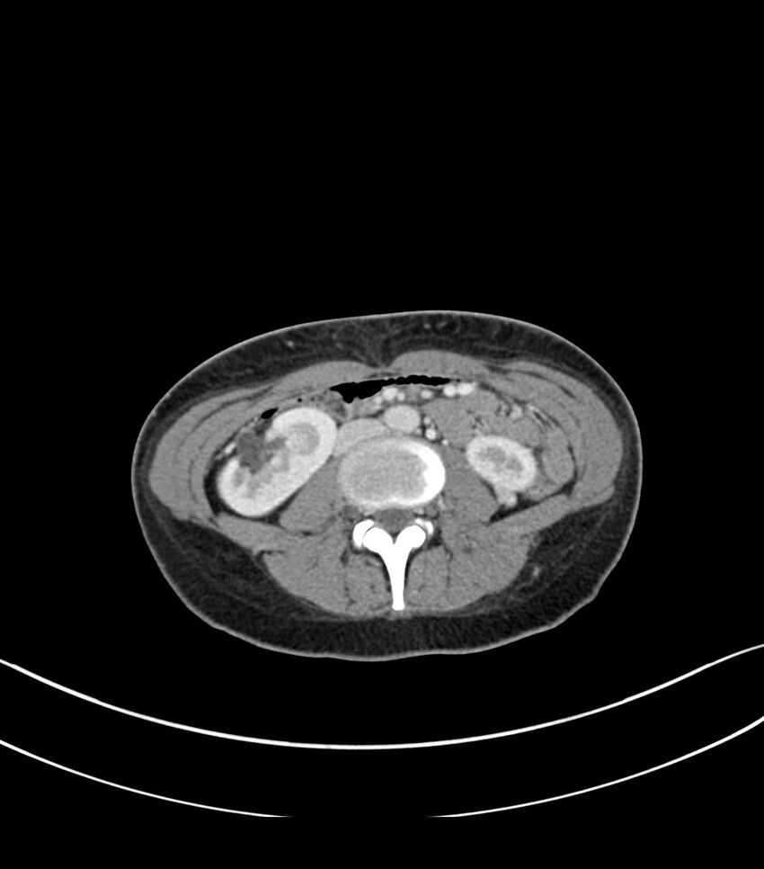 Bilateral kidney malrotation (Radiopaedia 72227-82749 A 34).jpg