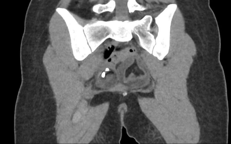 File:Bilateral mature cystic ovarian teratoma (Radiopaedia 88821-105592 Coronal non-contrast 30).jpg