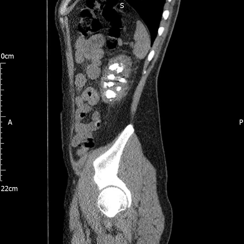 Bilateral medullary nephrocalcinosis with ureteric calculi (Radiopaedia 71269-81569 C 28).jpg