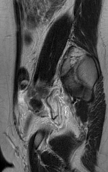 File:Bilateral ovarian fibrothecomas - adolescent (Radiopaedia 86604-102707 Sagittal T2 26).jpg
