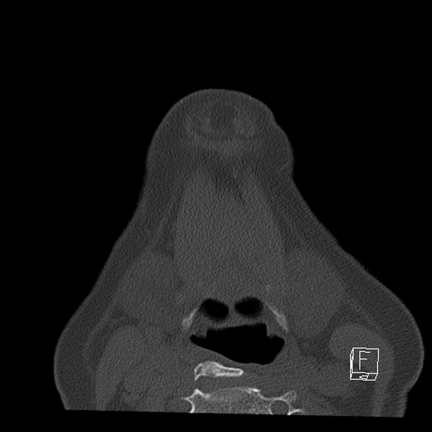 Bilateral palatine tonsilloliths on OPG and CT (Radiopaedia 75167-86247 Axial bone window 60).jpg