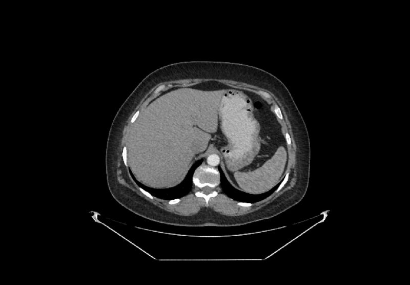 File:Bilateral urolithiasis with incidentally detected splenic artery aneurysm and left inferior vena cava (Radiopaedia 44467-48127 A 1).jpg