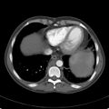 Biliary necrosis - liver transplant (Radiopaedia 21876-21846 A 6).jpg