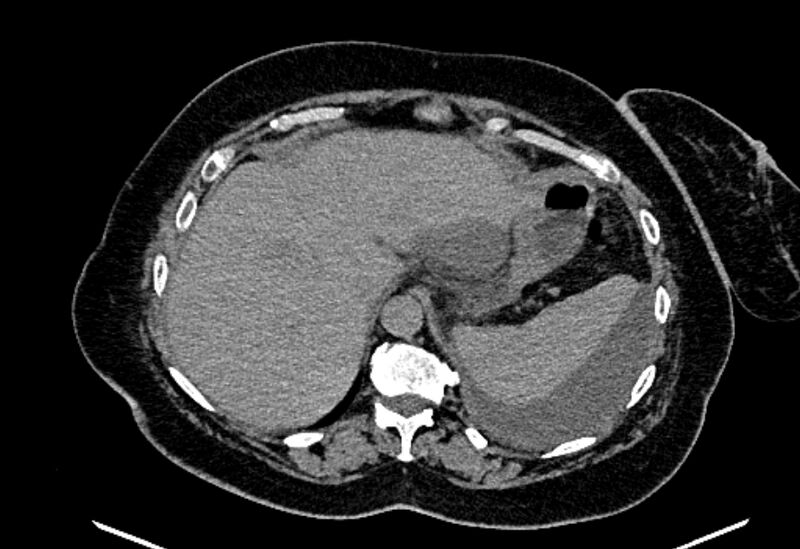 File:Biliary pancreatitis (Radiopaedia 72289-82823 Axial non-contrast 64).jpg