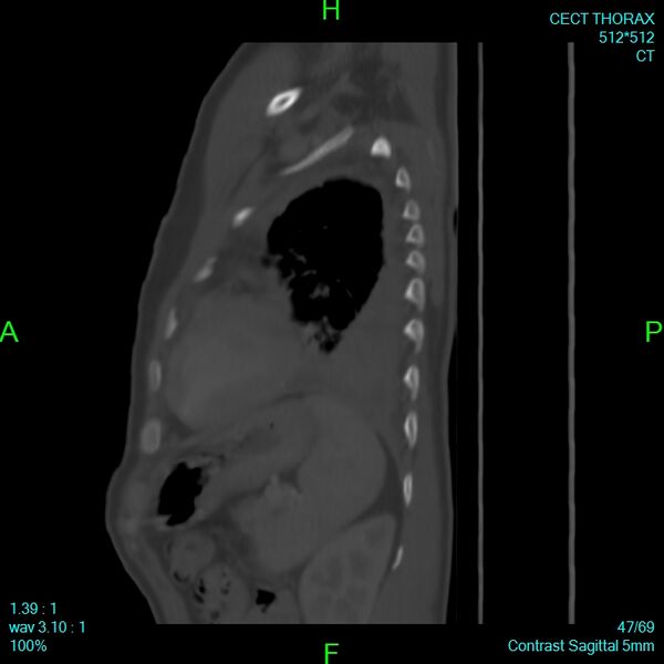 File:Bone metastases from lung carcinoma (Radiopaedia 54703-60937 Sagittal bone window 47).jpg