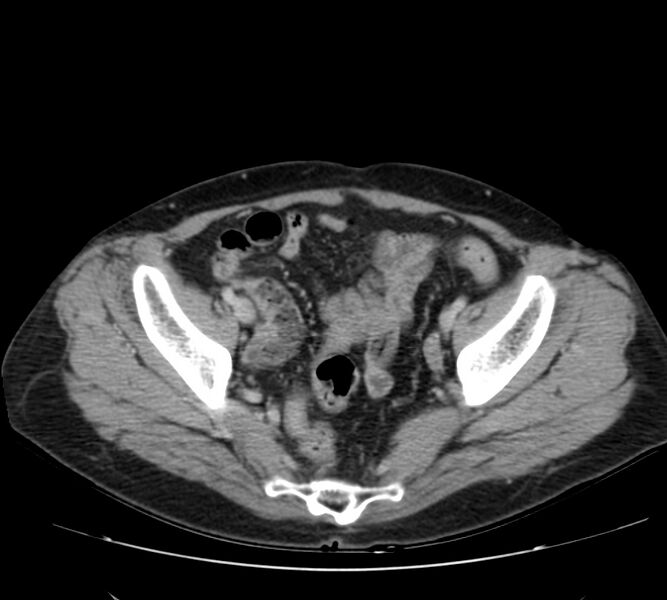 File:Bosniak renal cyst - type IV (Radiopaedia 22929-22953 C 56).jpg