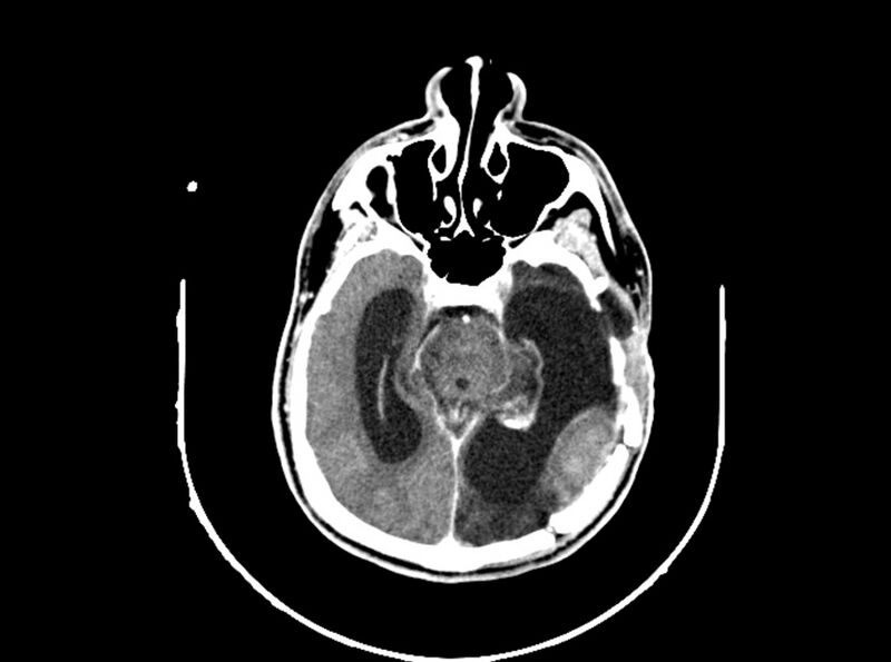 File:Brain injury by firearm projectile (Radiopaedia 82068-96088 B 110).jpg