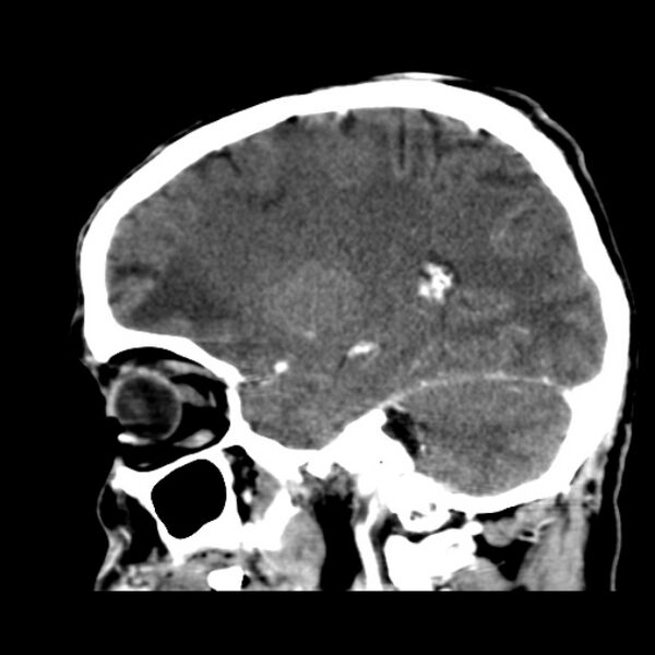 File:Brain metastases from lung cancer (Radiopaedia 24480-24781 C+ delayed 39).jpg