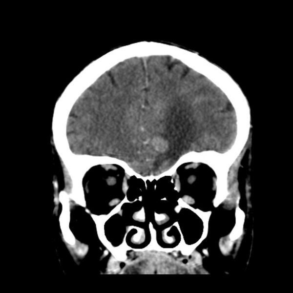 File:Brain metastases from lung cancer (Radiopaedia 24480-24781 Coronal C+ delayed 15).jpg
