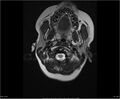 Brainstem glioma (Radiopaedia 21819-21775 Axial T2 2).jpg
