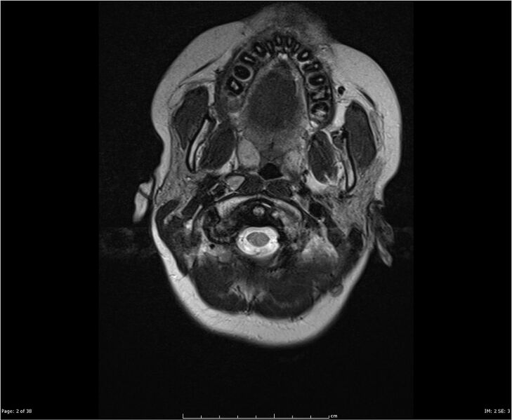 File:Brainstem glioma (Radiopaedia 21819-21775 Axial T2 2).jpg