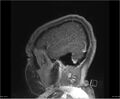 Brainstem glioma (Radiopaedia 21819-21775 D 5).jpg