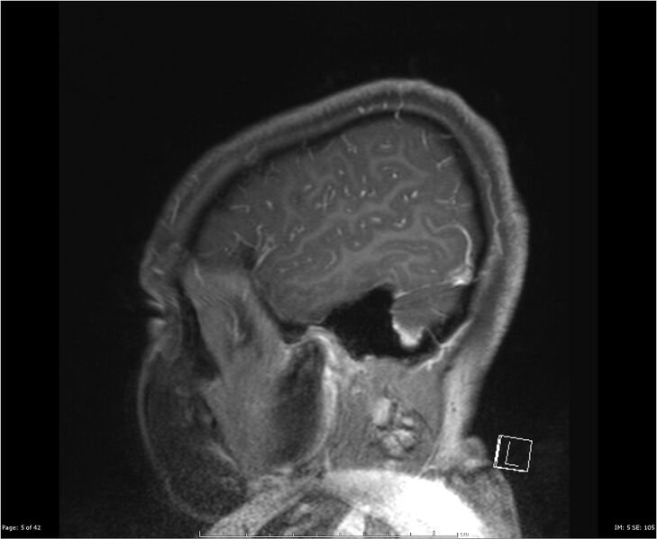 File:Brainstem glioma (Radiopaedia 21819-21775 D 5).jpg