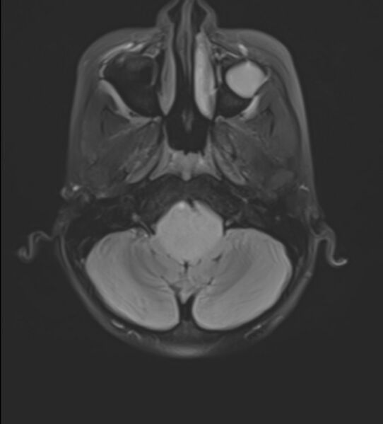 File:Brainstem glioma (Radiopaedia 70548-80674 Axial FLAIR 5).jpg