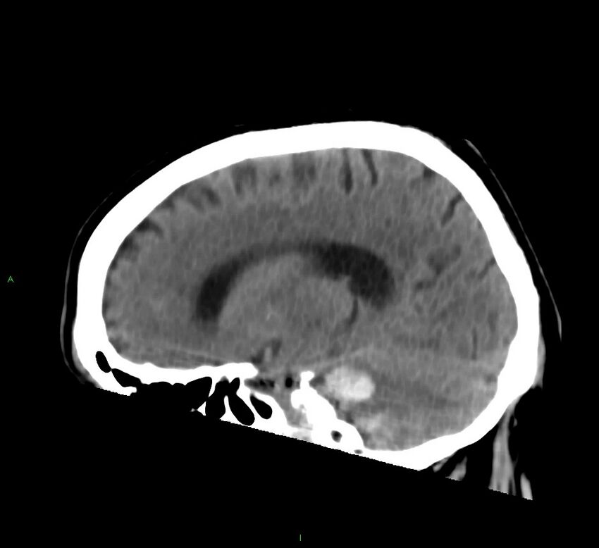 Brainstem hemorrhage (Radiopaedia 58794-66028 C 20).jpg